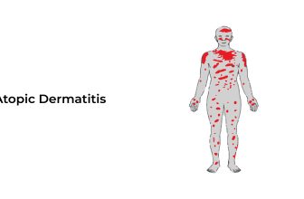 Atopic-Dermatitis