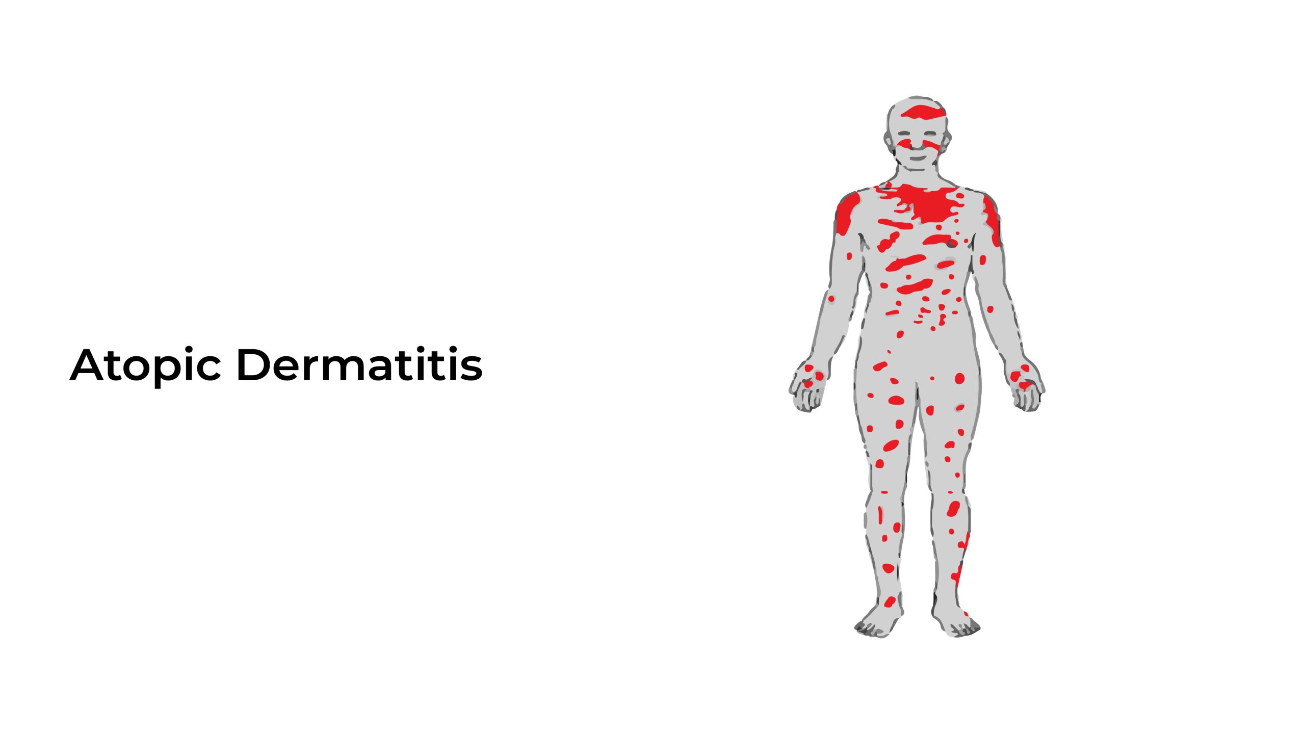 Atopic Dermatitis Types Causes And Treatment Healthcare City