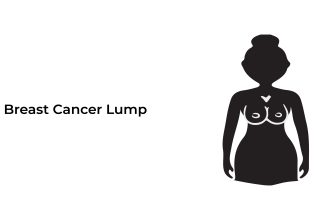 Breast-cancer-lump