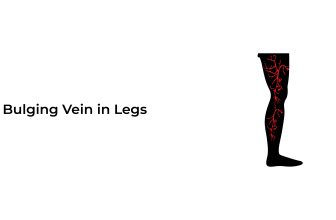 Bulging-veins-in-Legs