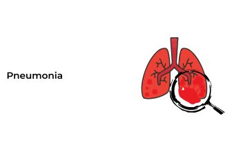 Pneumonia
