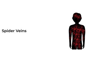 Spider-veins