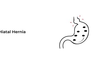 Hiatal-Hernia
