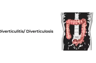 Diverticulitis-Diverticulosis-Recovered-01-1024x576