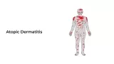 Atopic Dermatitis