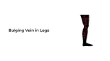 Bulging veins in Legs