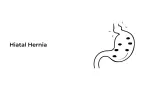 Hiatal Hernia