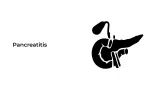 Pancreatitis
