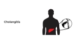 Cholangitis